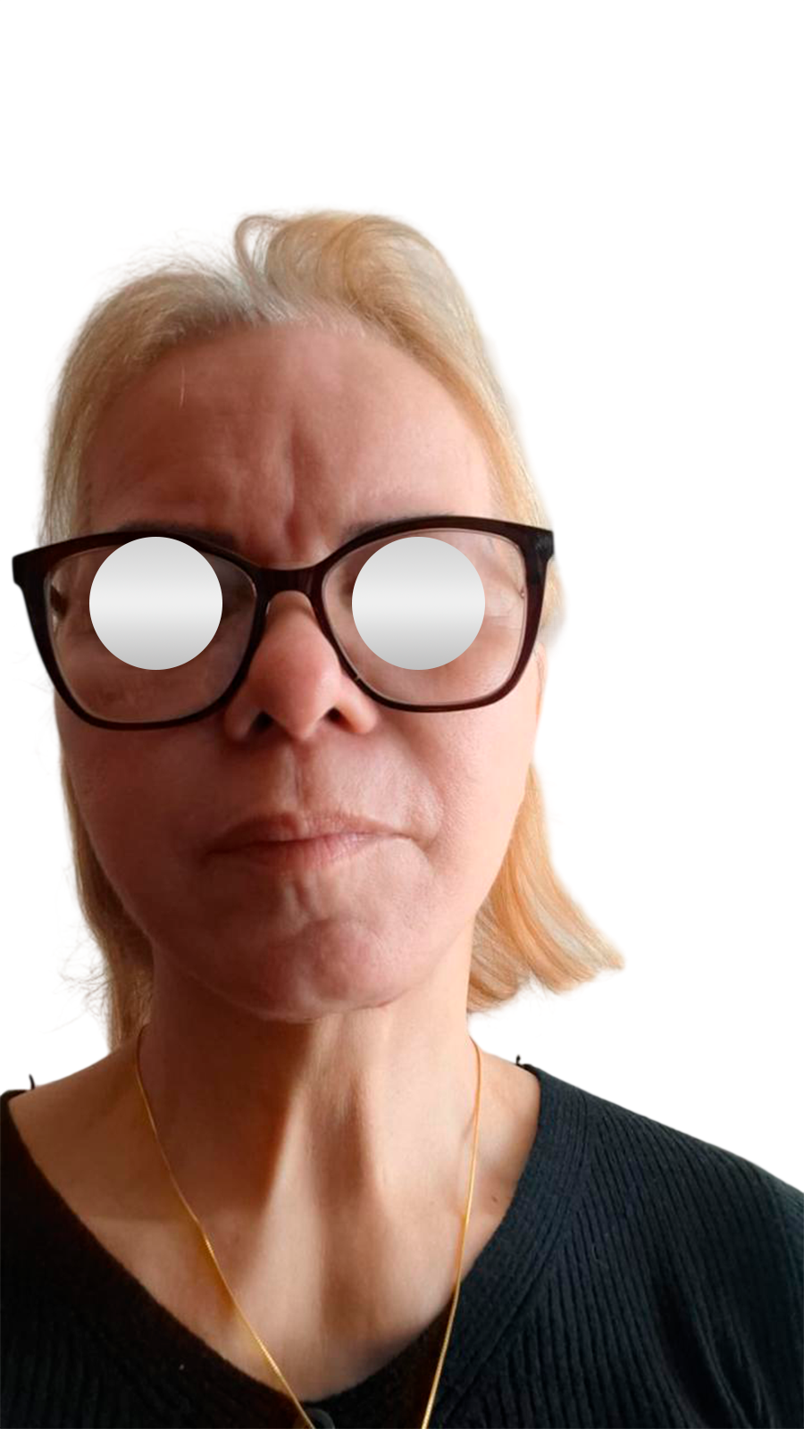 Antes do lifting facial — Frontal