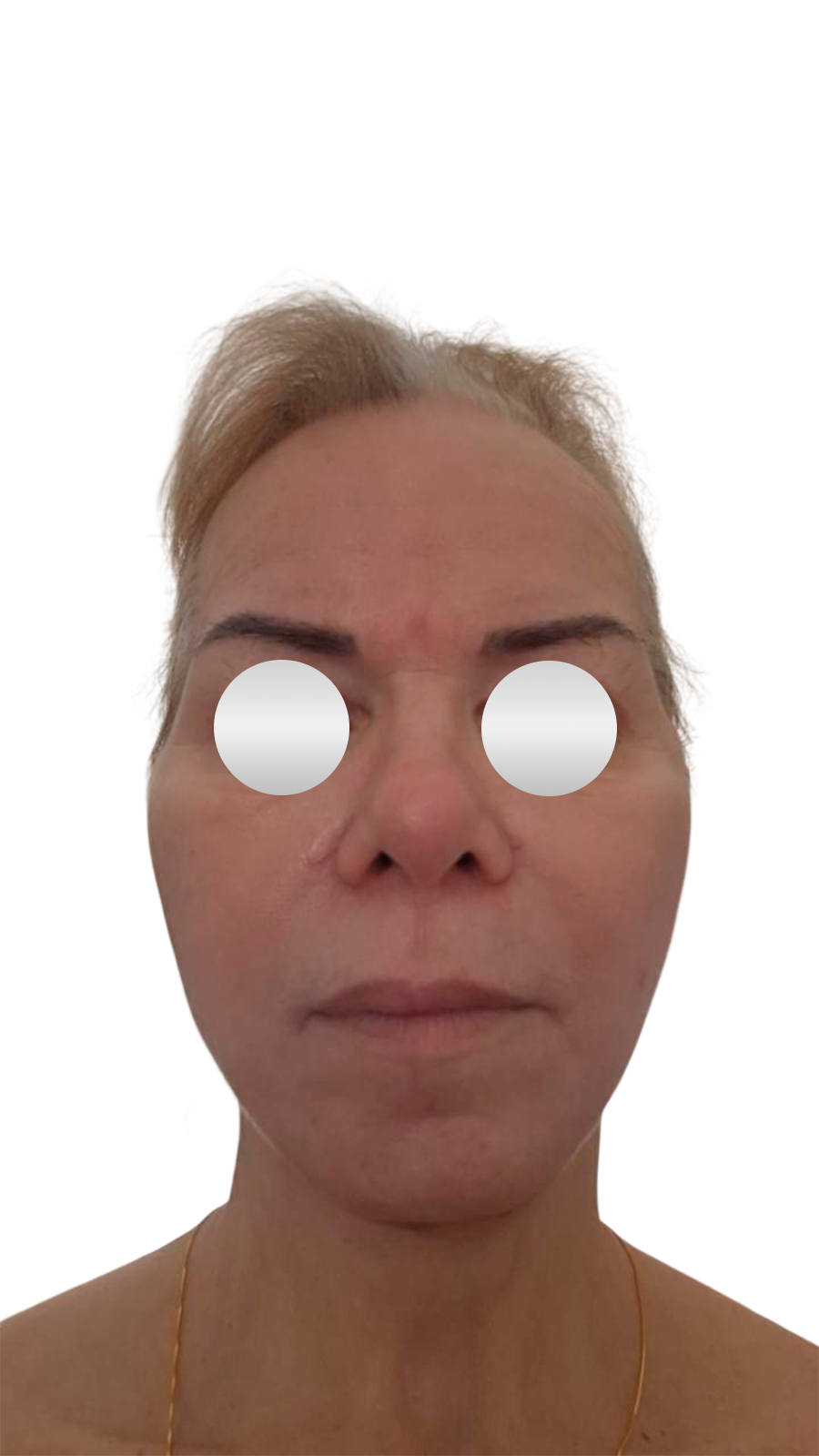 Depois do lifting facial — Frontal